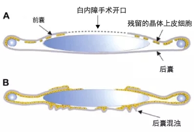 轻度白内障需要手术吗_轻度白内障可以恢复吗_轻度白内障怎么办